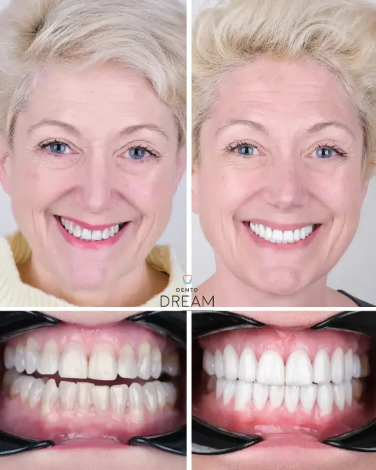 Before and after dental smile case 1