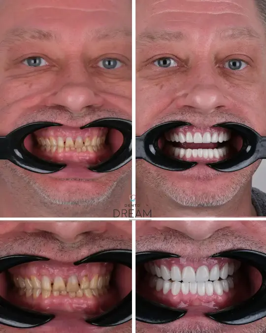 Before and after dental smile case 10