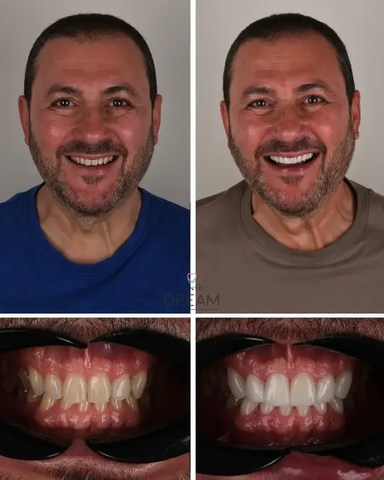 Before and after dental smile case 11