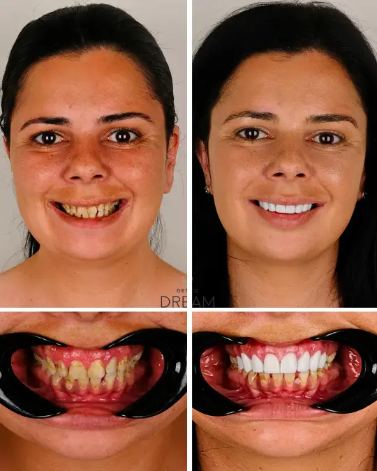 Before and after dental smile case 12