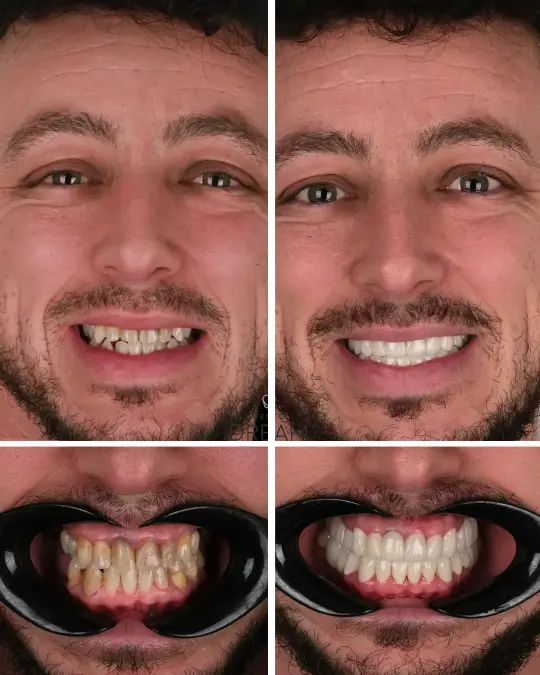Before and after dental smile case 16