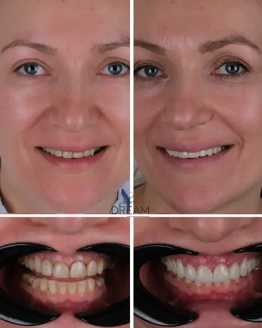 Before and after dental smile case 17