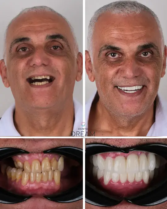 Before and after dental smile case 18