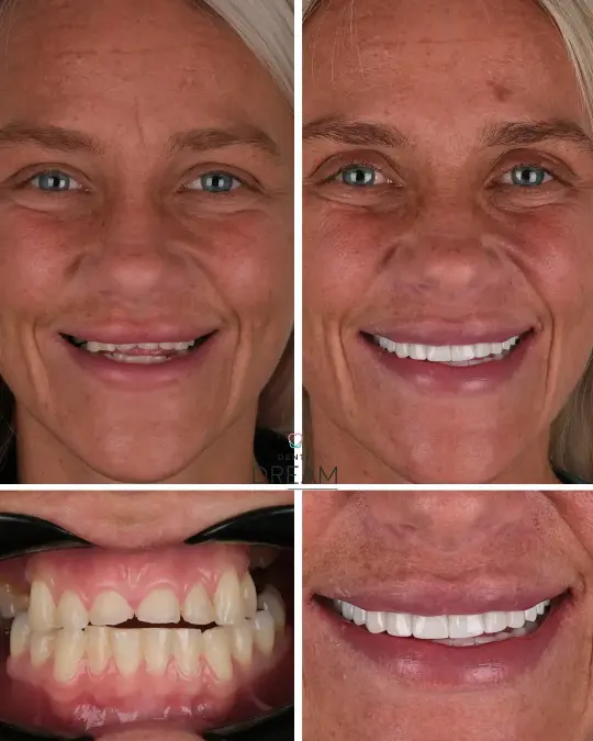 Before and after dental smile case 20