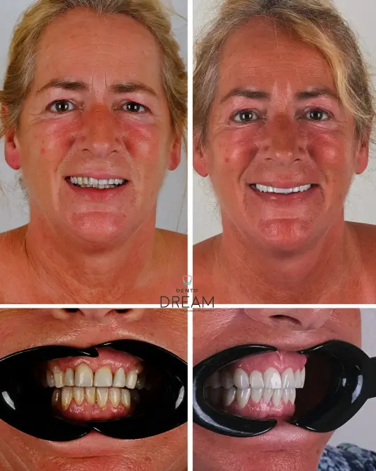 Before and after dental smile case 21