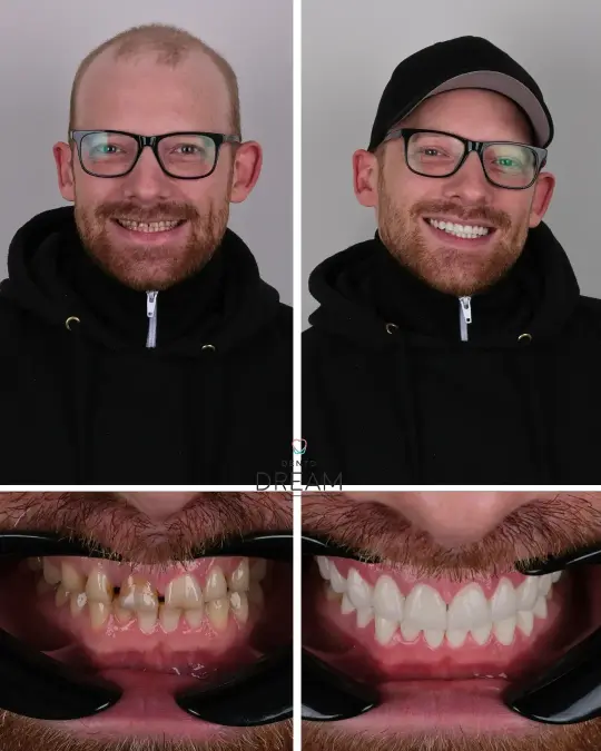Before and after dental smile case 24
