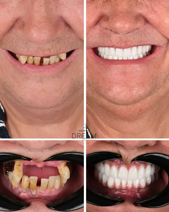 Before and after dental smile case 25