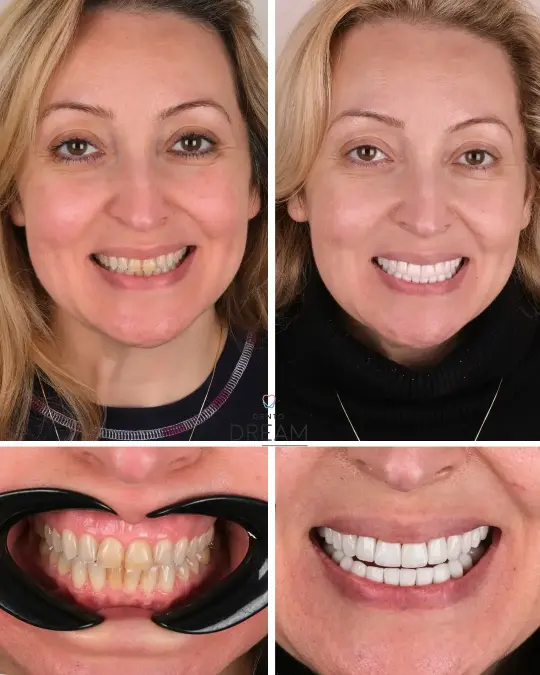 Before and after dental smile case 26