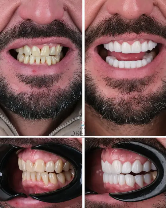 Before and after dental smile case 28