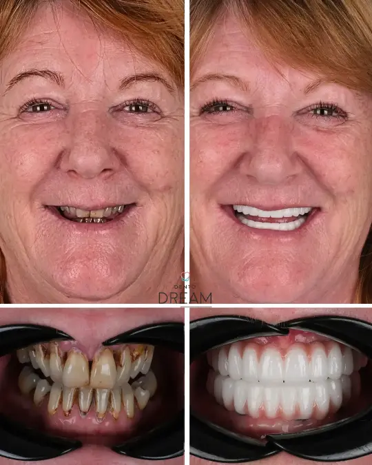 Before and after dental smile case 29