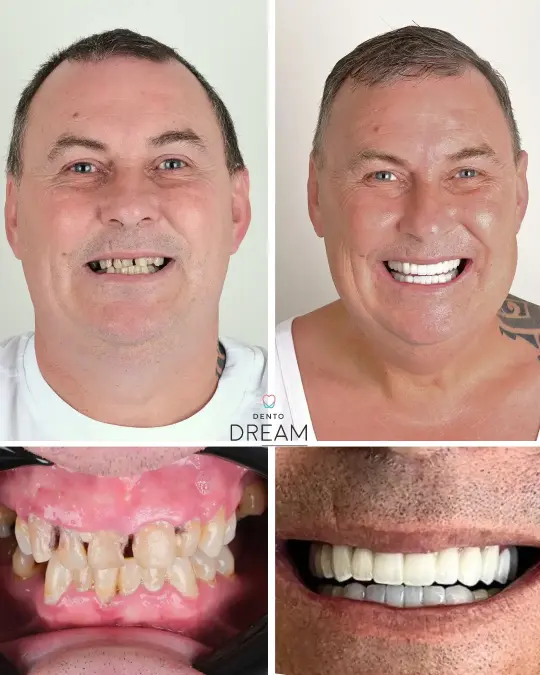 Before and after dental smile case 3