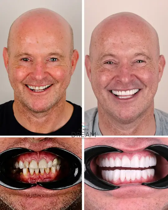 Before and after dental smile case 5