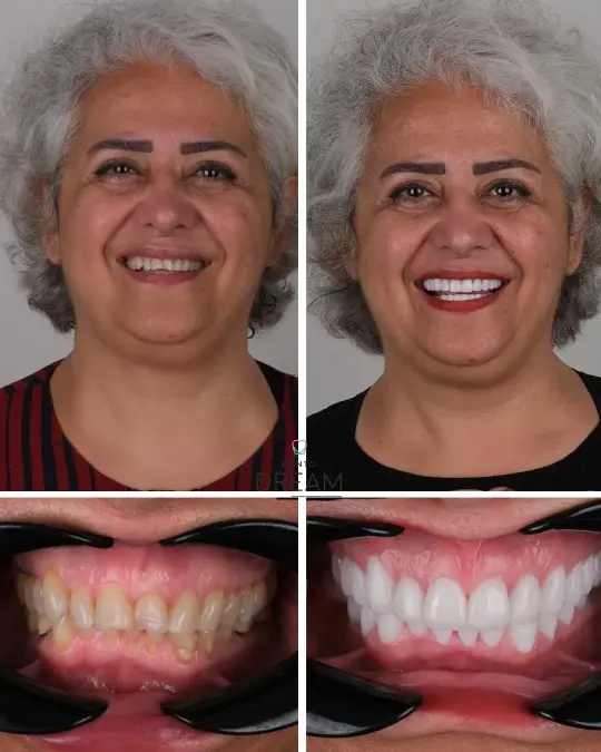 Before and after dental smile case 6
