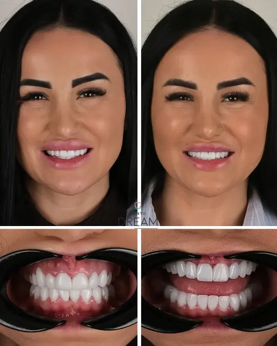 Before and after dental smile case 8