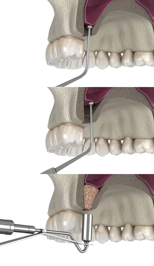 Bone Graft Operation